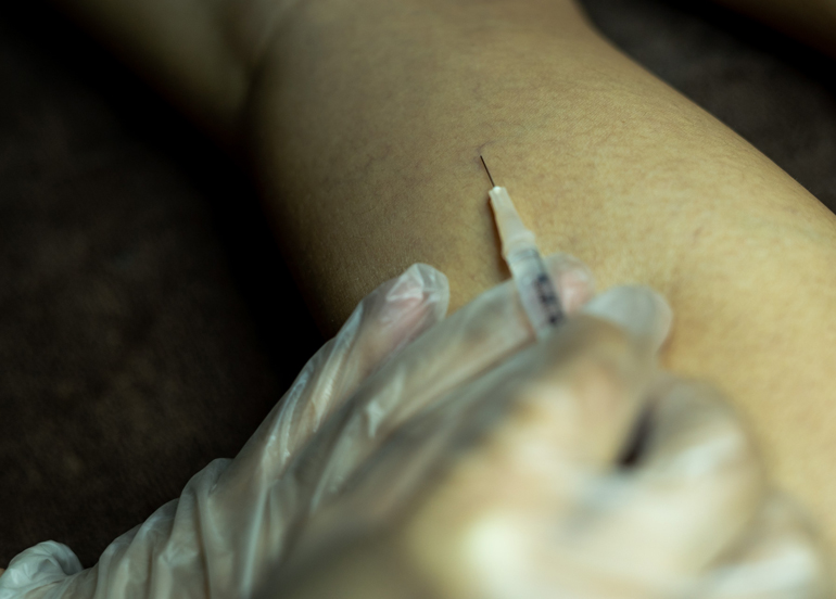 centro-estetico-sclerotherapy-spider-vein-injection