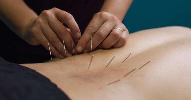 Dry Needling