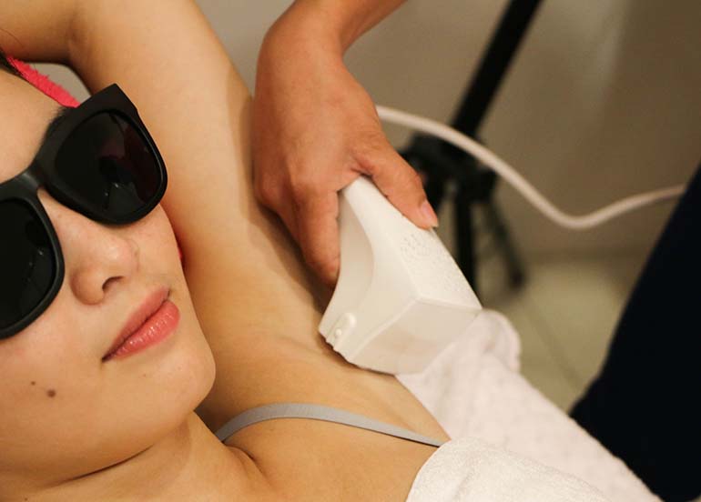 IPL-laser-underarm