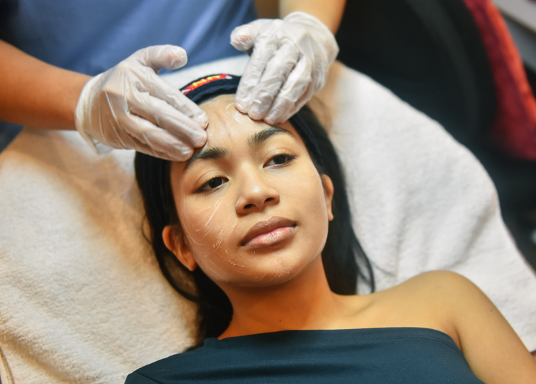 photofacial-treatment