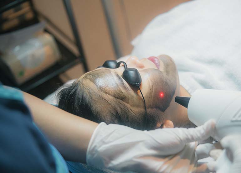 carbon-laser-treatment