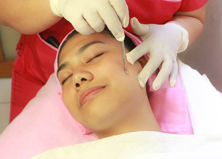 Client getting a white head or black head removal